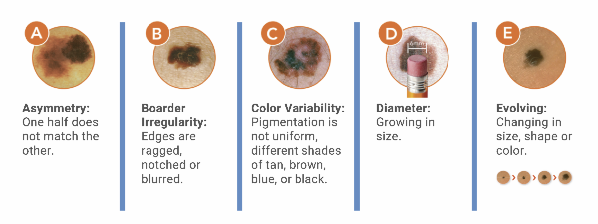 Types of skin cancer that is treated at Pure Dermatology