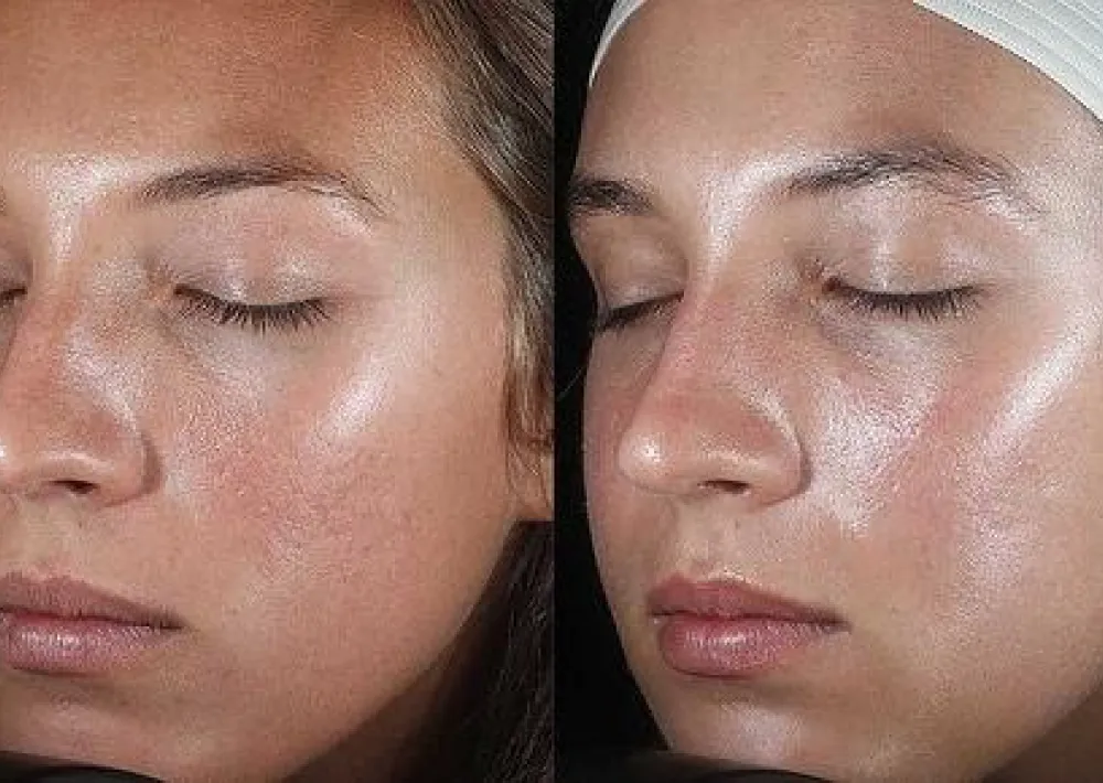 pure-dermatology-silk-peel-treatment-results