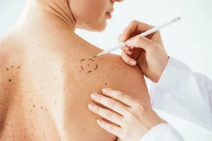 pure-dermatology-mole-removal-101